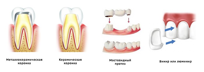 Протезирование зубов в Киеве